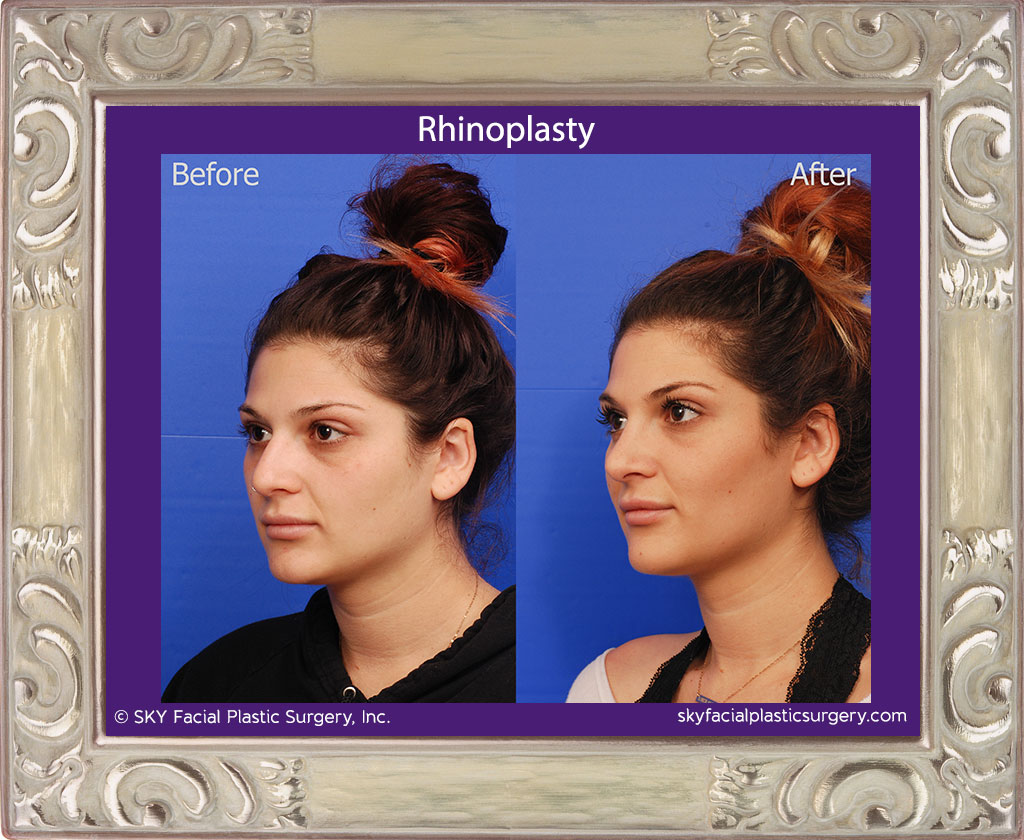 Rhinoplasty