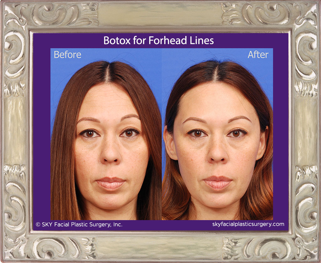 Botox for forehead lines