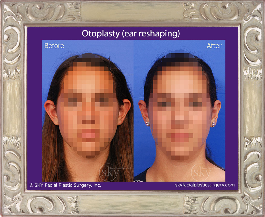 Otoplasty