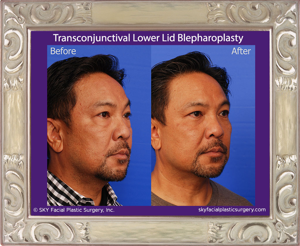 Scarless lower eyelid surgery