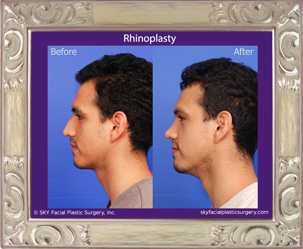 Male Rhinoplasty