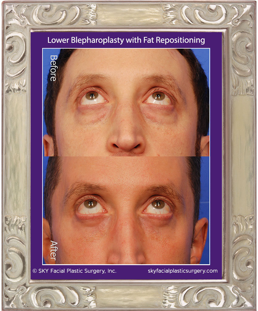 Transconjunctival Lower Lid Blepharoplasty with Fat Repositioning