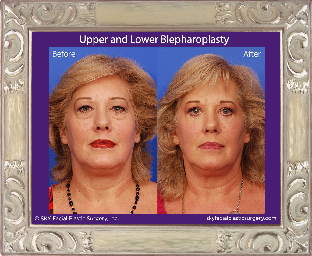 Upper and Lower Blepharoplasty with Fat Repositioning