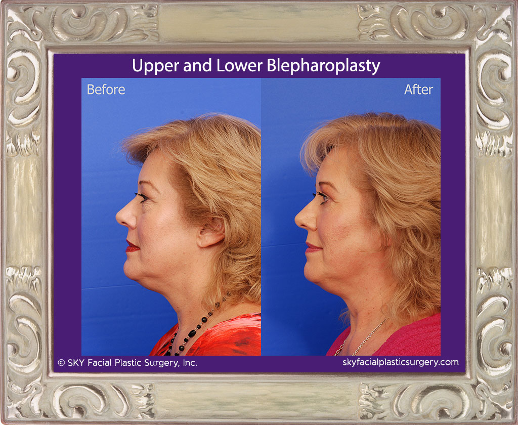 Upper and Lower Blepharoplasty with Fat Repositioning