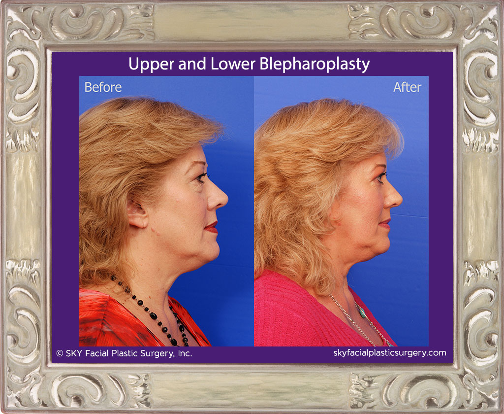 Upper and Lower Blepharoplasty with Fat Repositioning