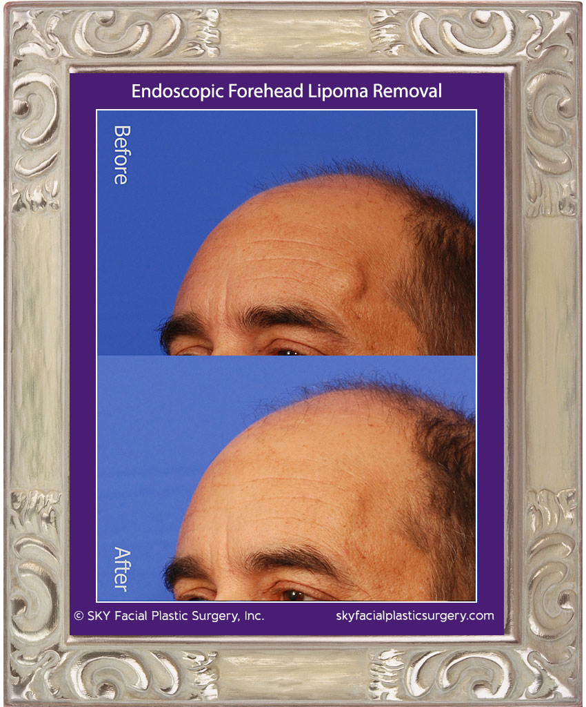 Scarless forehead lipoma removal