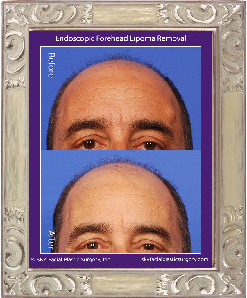 Scarless Forehead Lipoma Removal