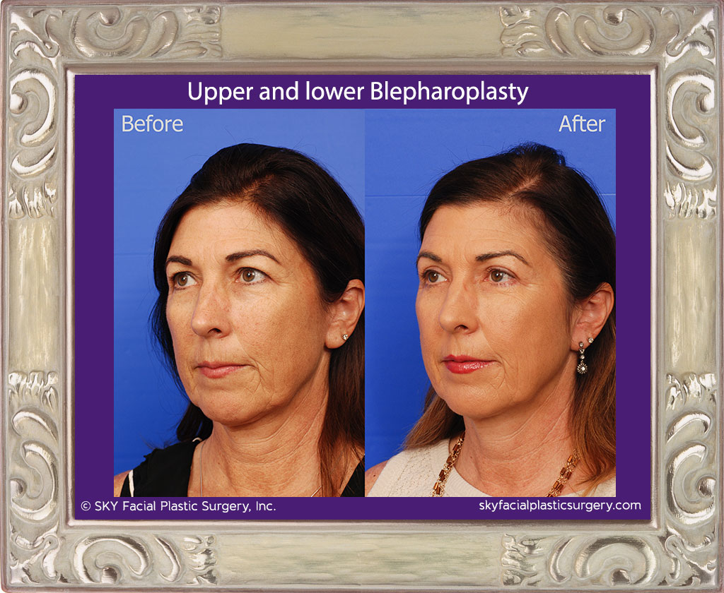 Upper and lower blepharoplasty
