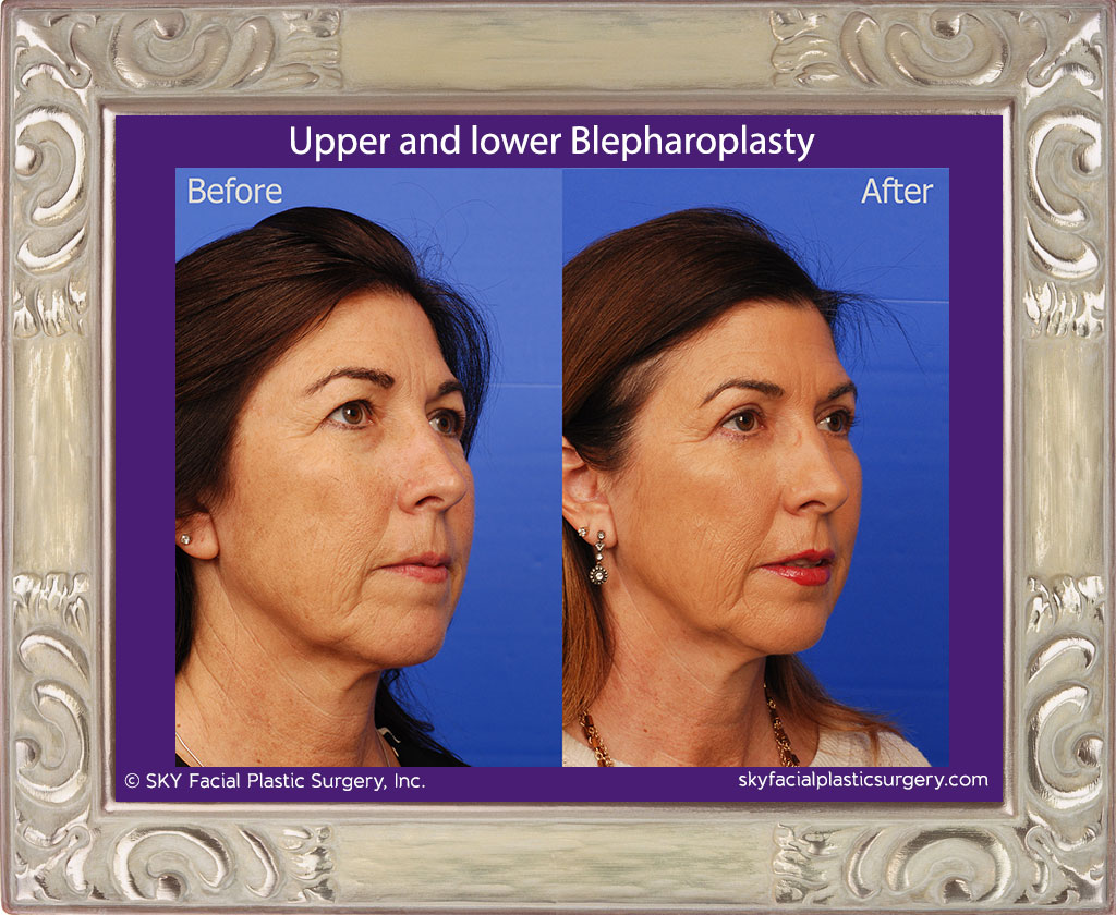 Upper and lower blepharoplasty