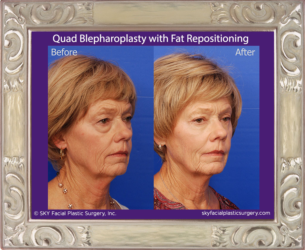 Upper and Lower Blepharoplasty