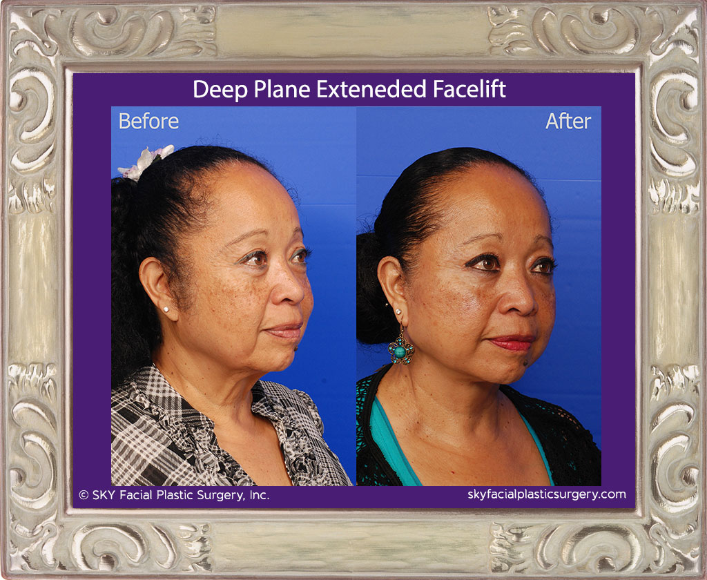 Deep plane extended facelift