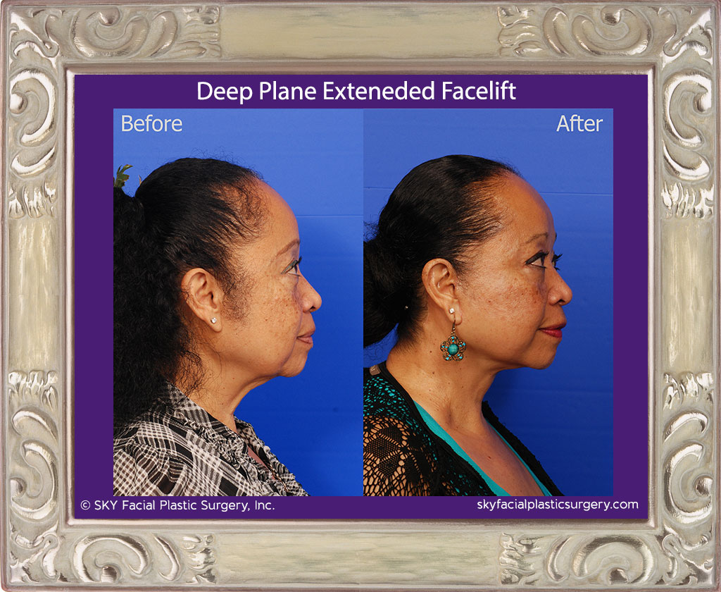 Deep plane extended facelift