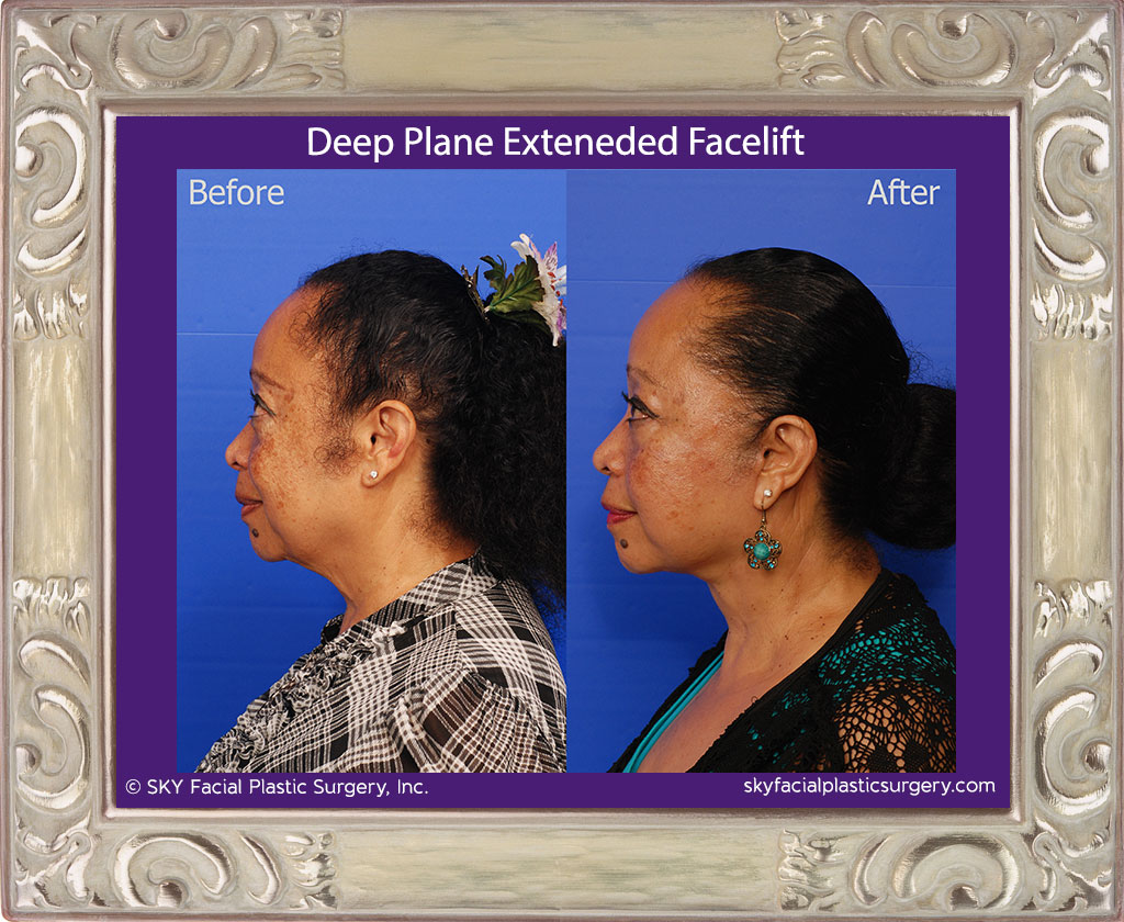 Deep plane extended facelift