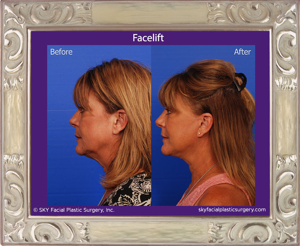 SKY-Facial-Plastic-Surgery-Facelift-15B.jpg