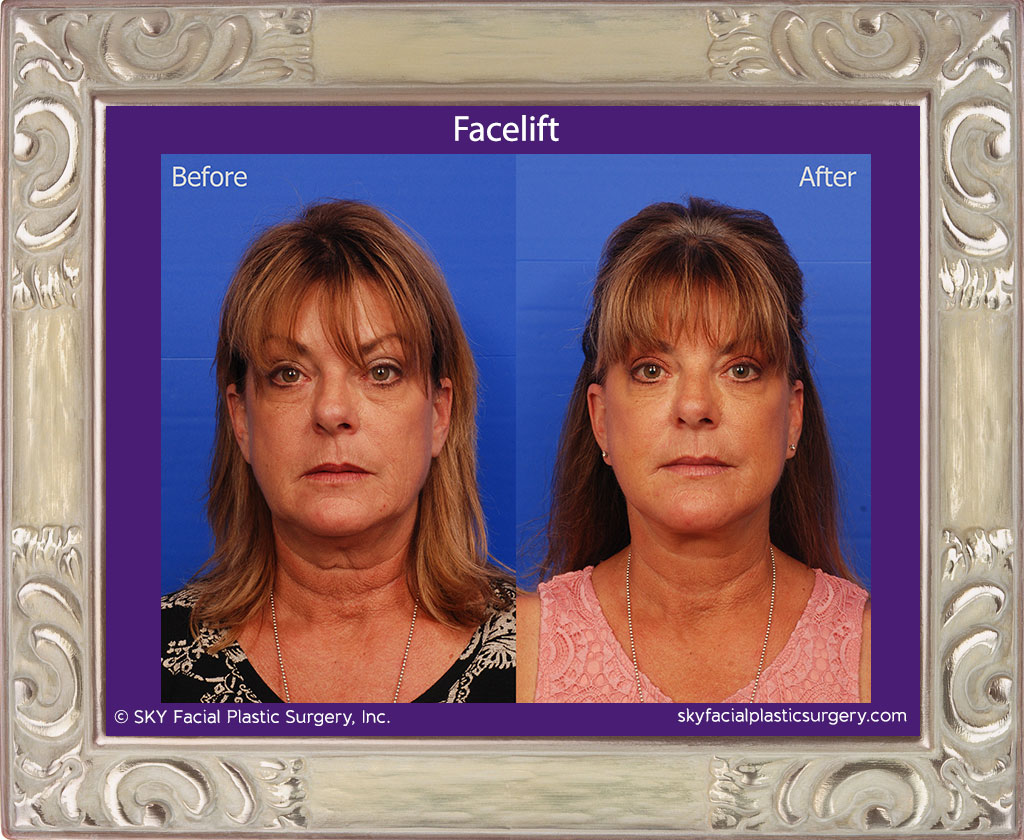 SKY-Facial-Plastic-Surgery-Facelift-15A.jpg