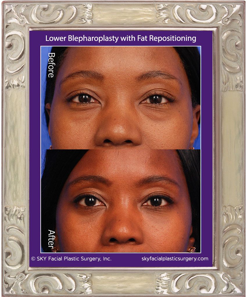Lower Blepharoplasty with fat repositioning