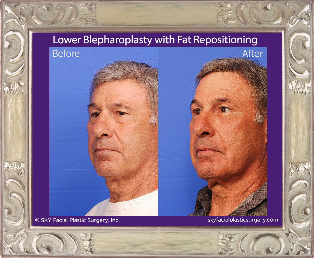 Lower Blepharoplasty with fat repositioning