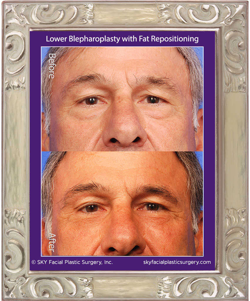 Lower Blepharoplasty with fat repositioning