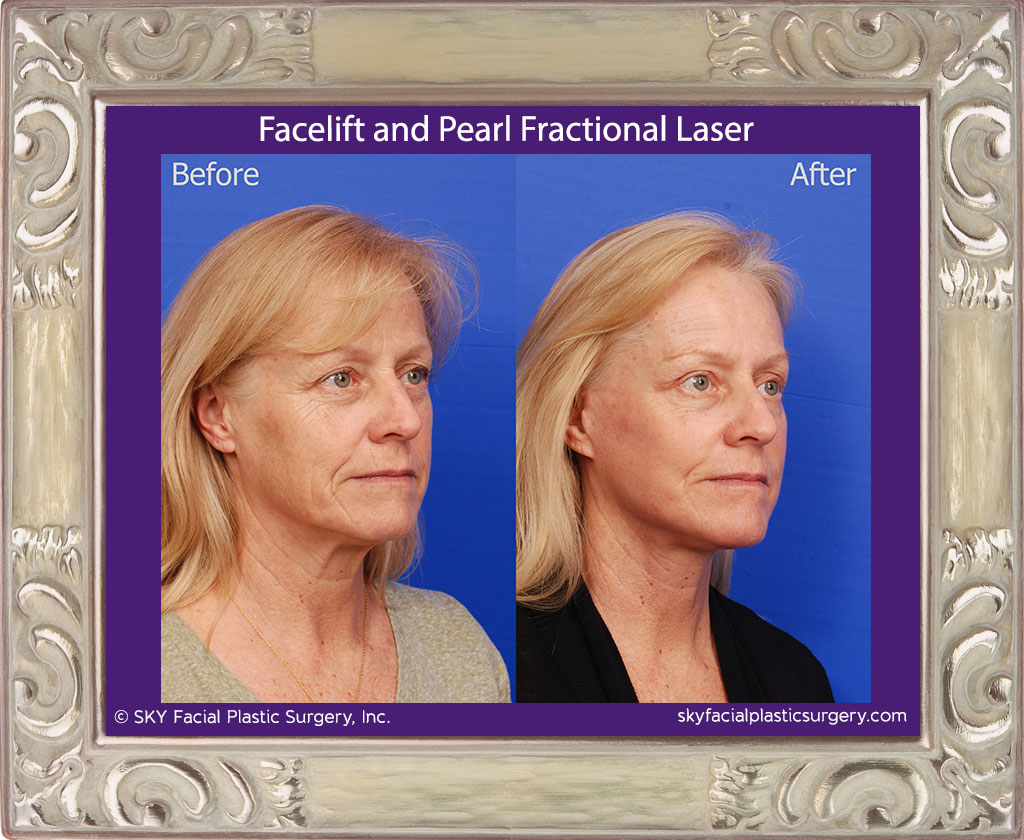 Facelift with Pearl Fractional Laser