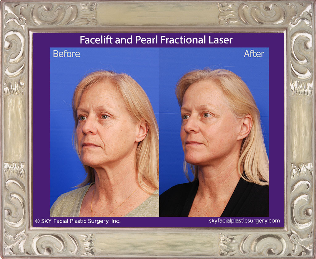 Facelift with Pearl Fractional Laser