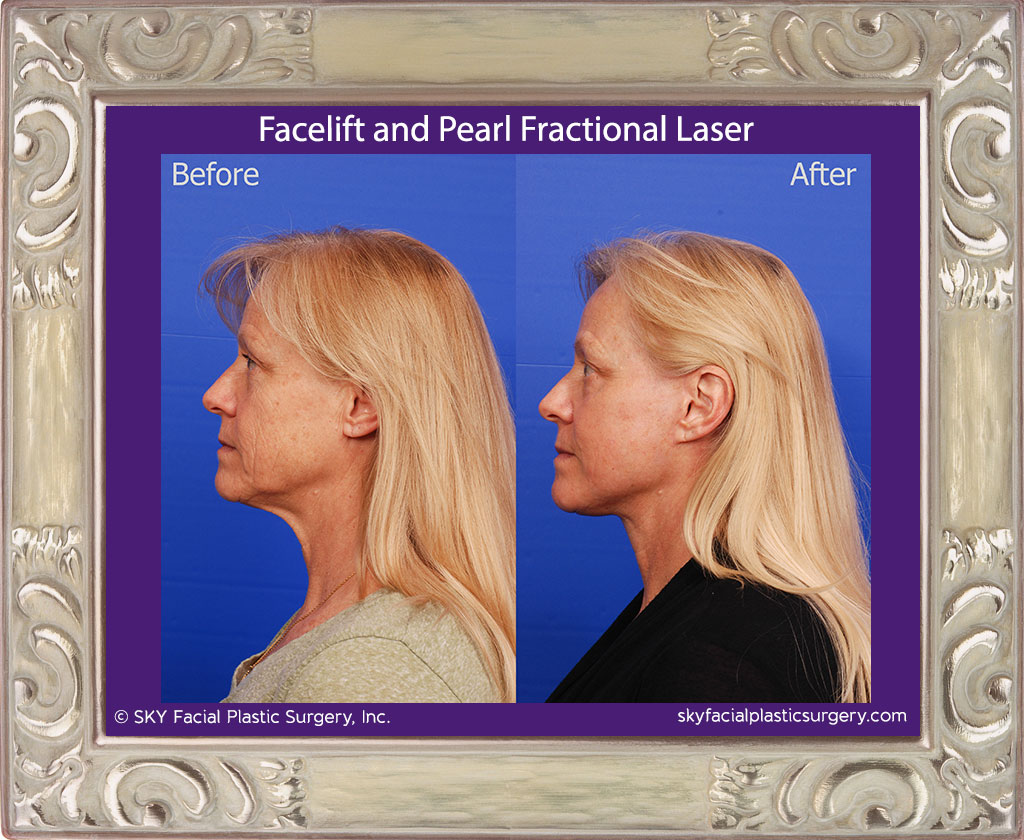 Facelift with Pearl Fractional Laser