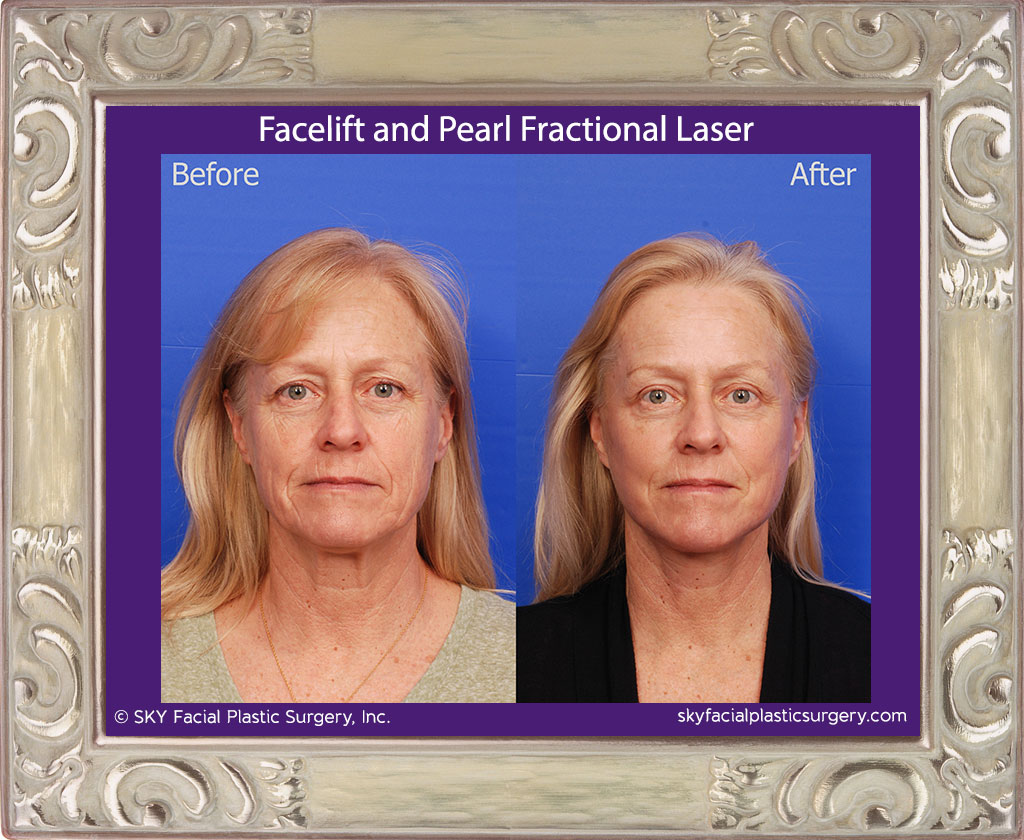 Facelift with Pearl Fractional Laser
