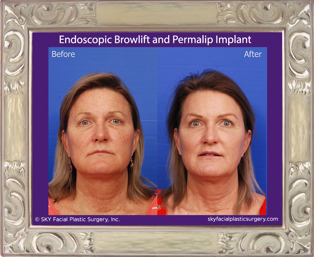 Endoscopic Browlift and Permalip Implant