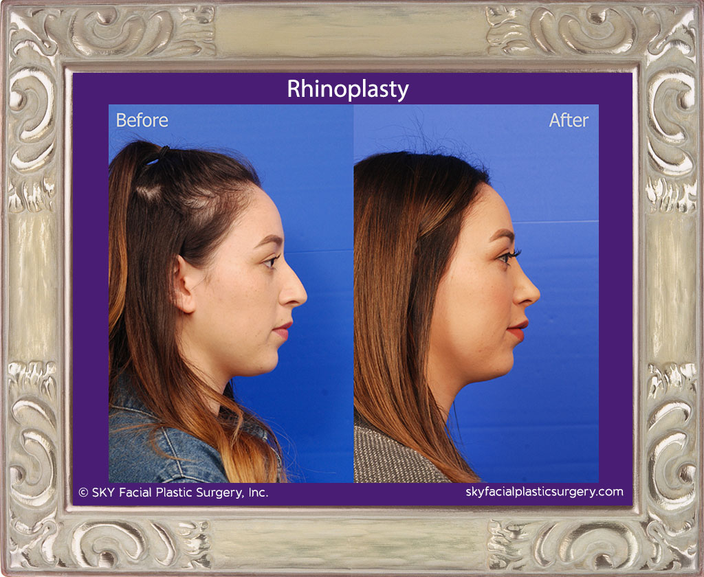 Rhinoplasty