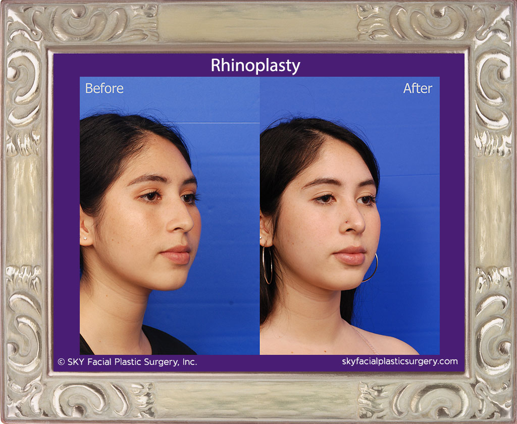 Cosmetic rhinoplasty