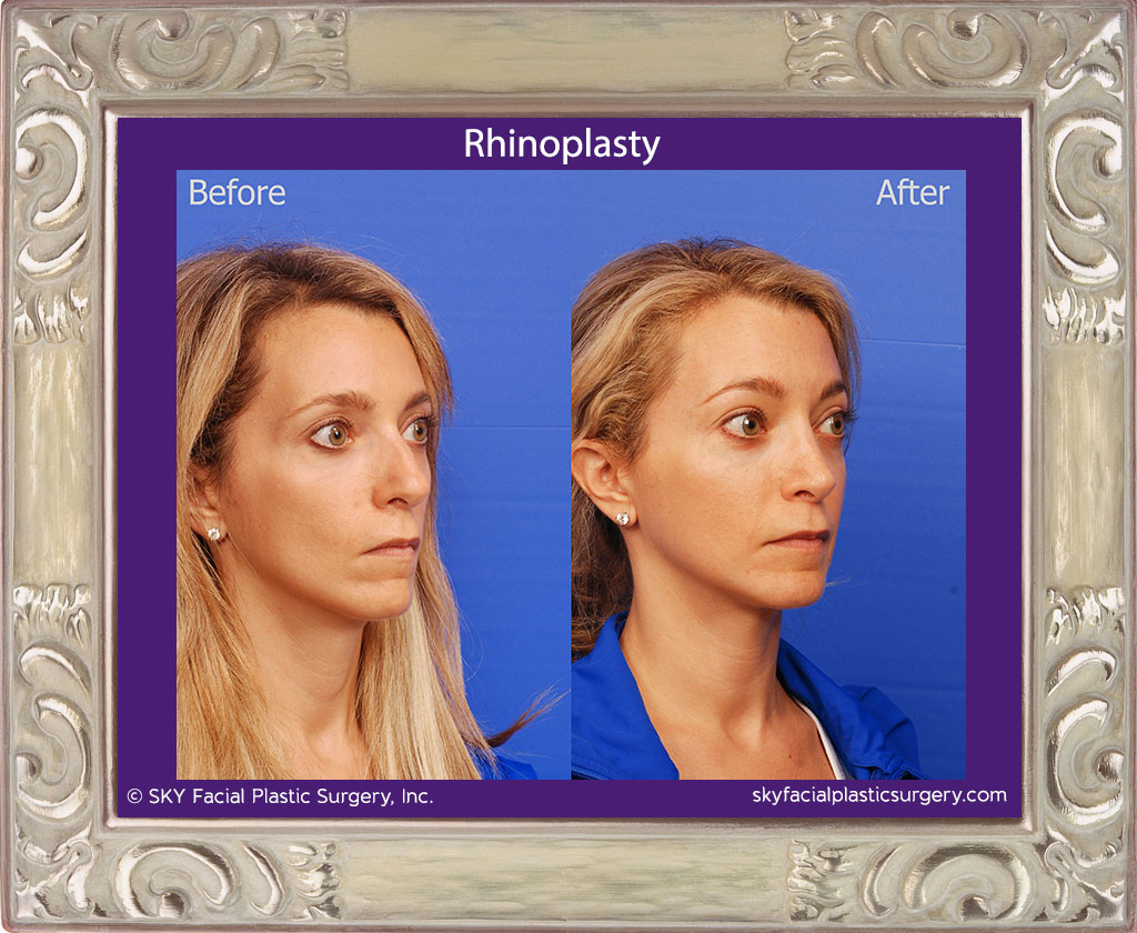 Rhinoplasty - San Diego