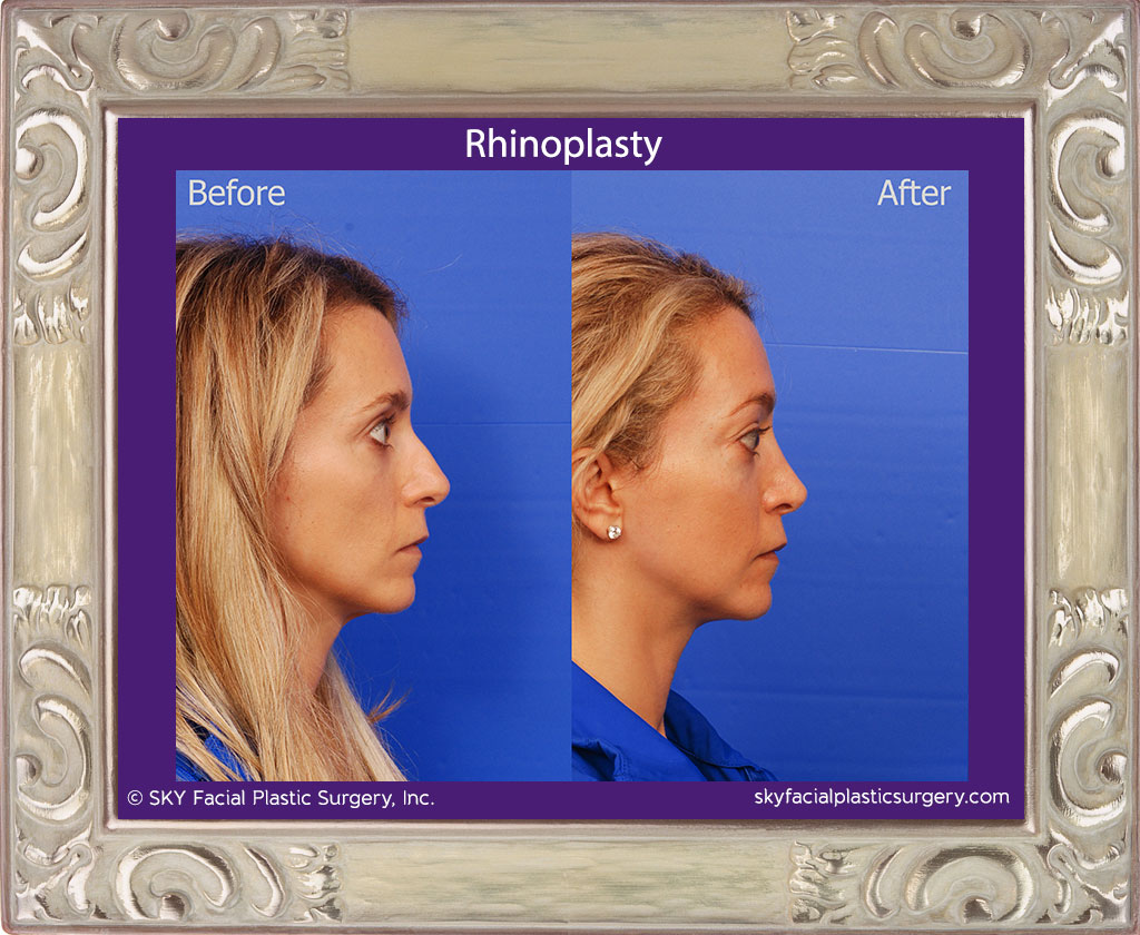 Rhinoplasty - San Diego