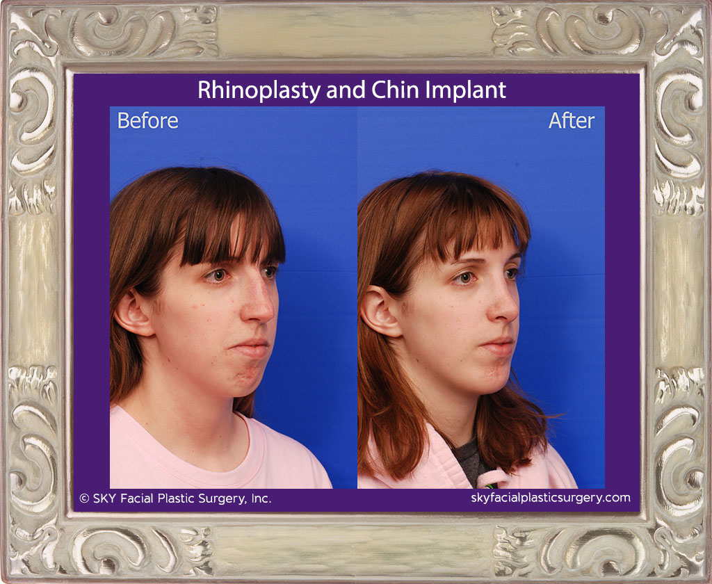 Rhinoplasty and Chin Implant - San Diego