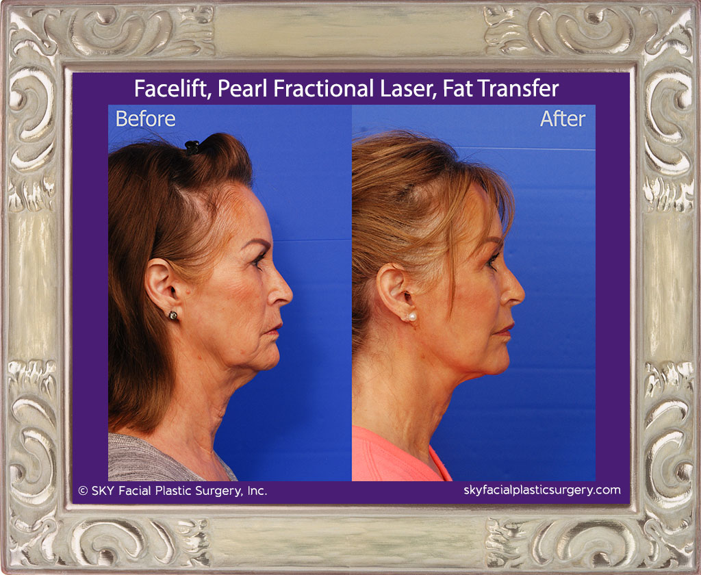 Facelift, Fat Transfer, Pearl Fractional Laser