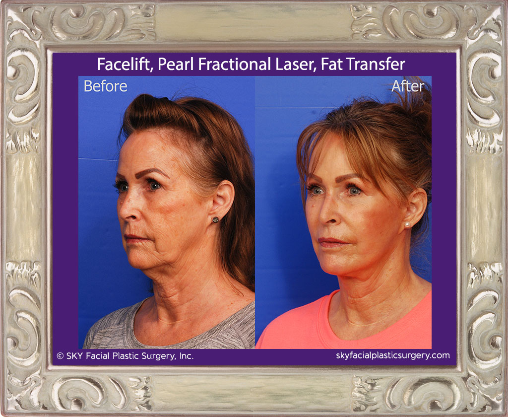 Facelift, Fat Transfer, Pearl Fractional Laser - San Diego