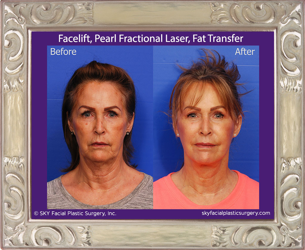 Facelift, Fat Transfer, Pearl Fractional Laser - San Diego