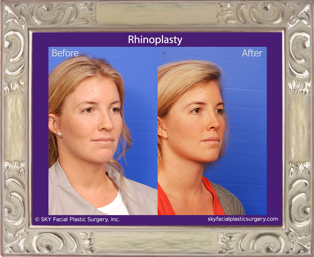 Rhinoplasty - San Diego