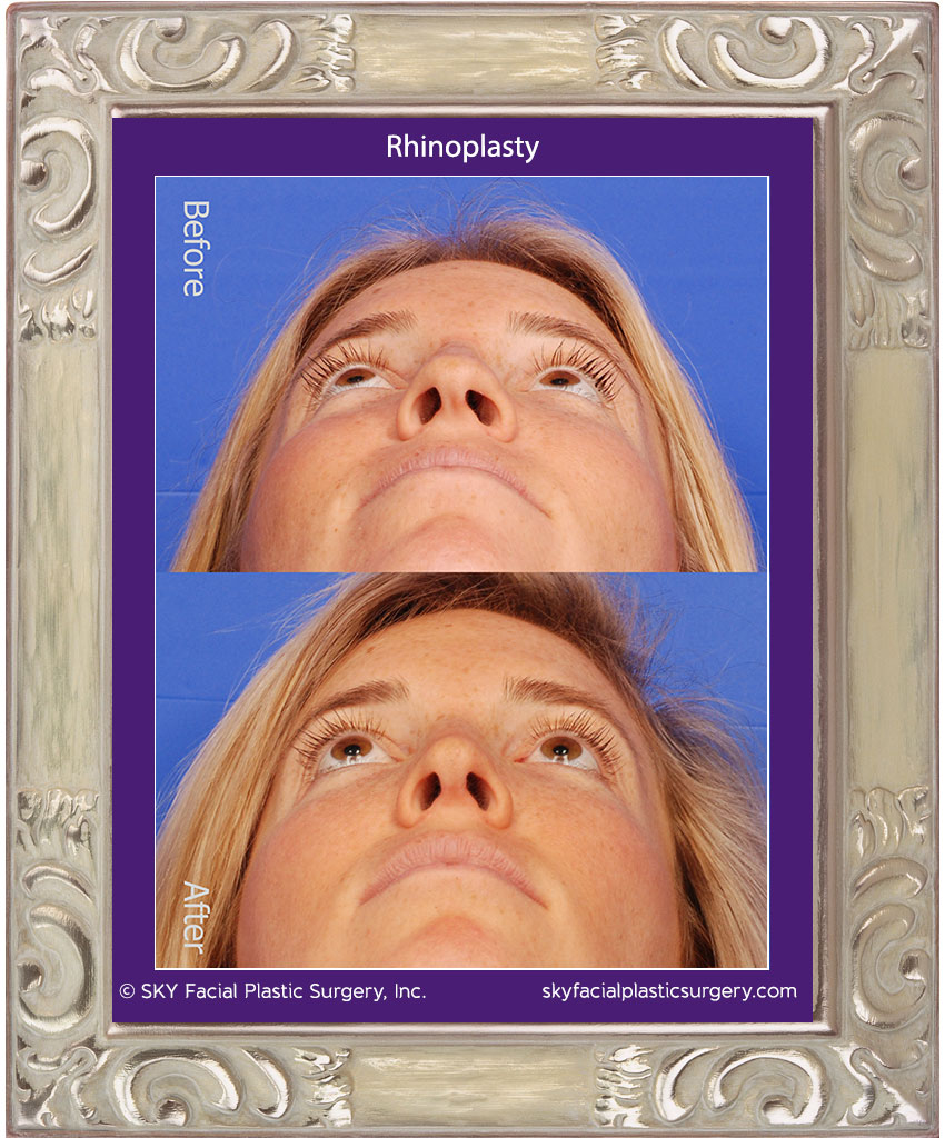 Rhinoplasty - San Diego