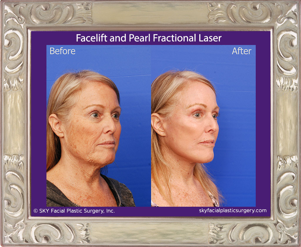 Facelift and Pearl Fractional Laser