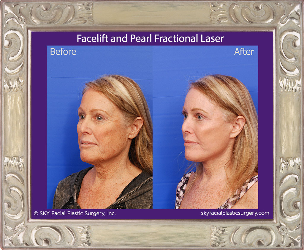 Facelift and Pearl Fractional Laser