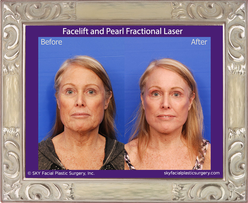 Facelift and Pearl Fractional Laser