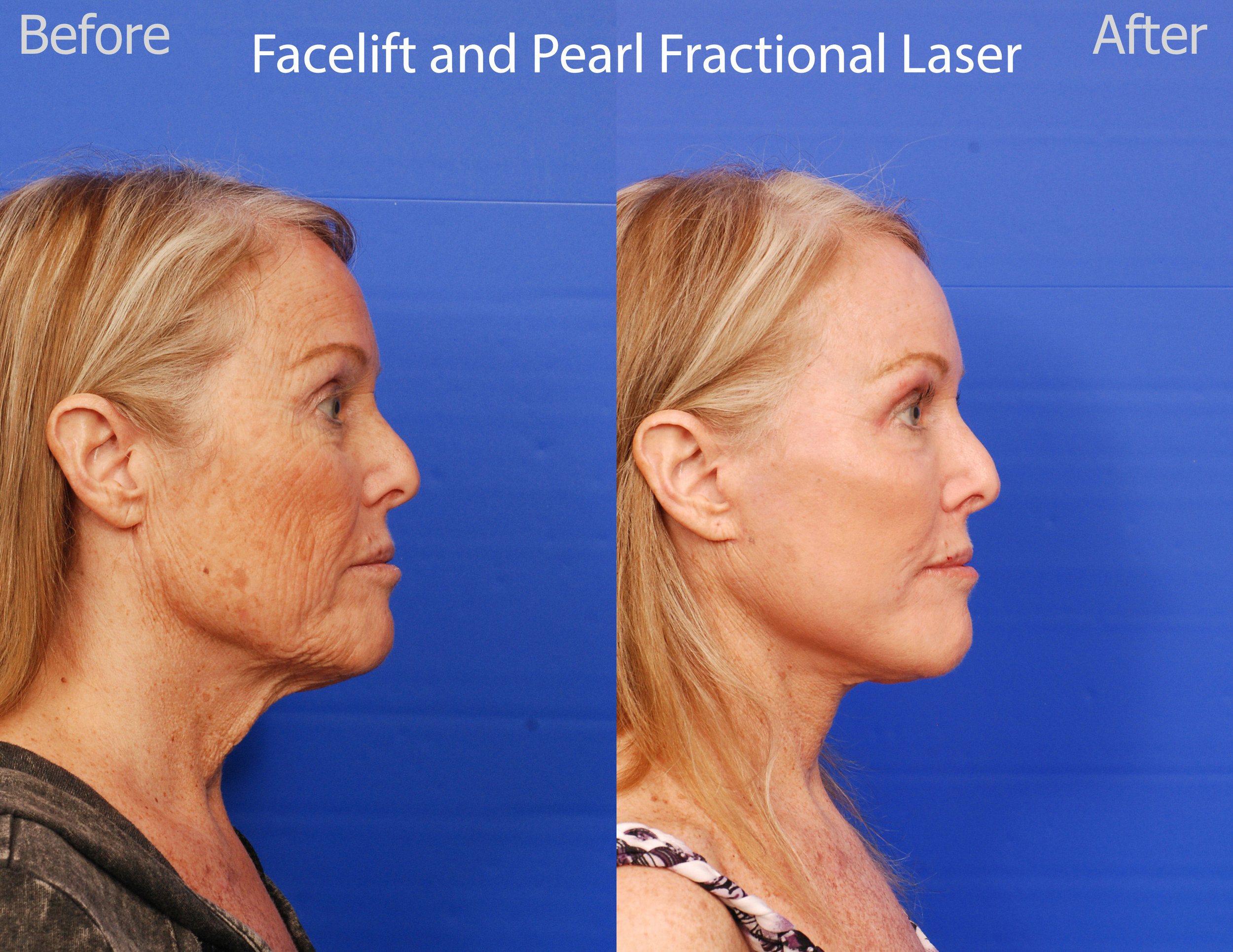 Facelift and Pearl Fractional Laser - San Diego