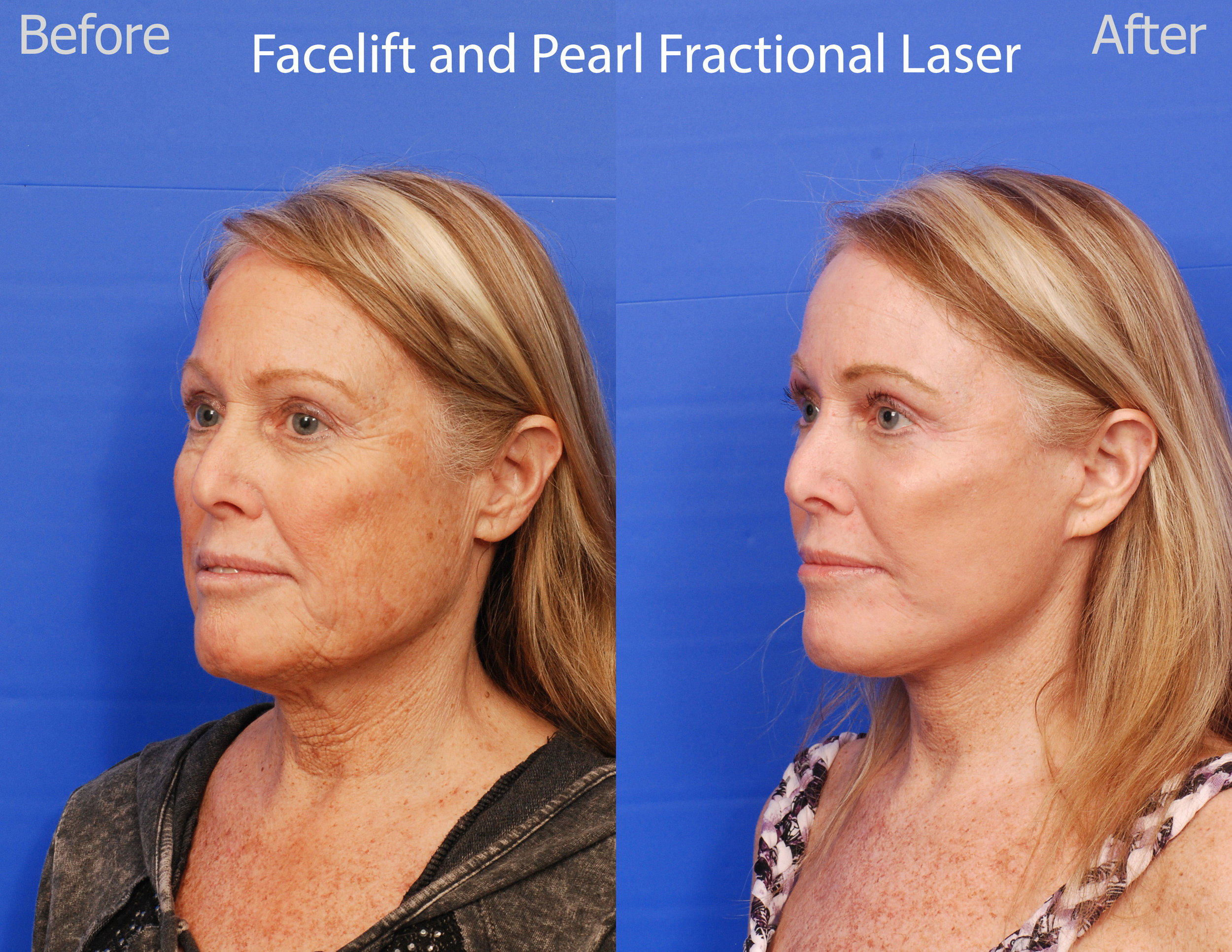 Facelift and Pearl Fractional Laser - San Diego