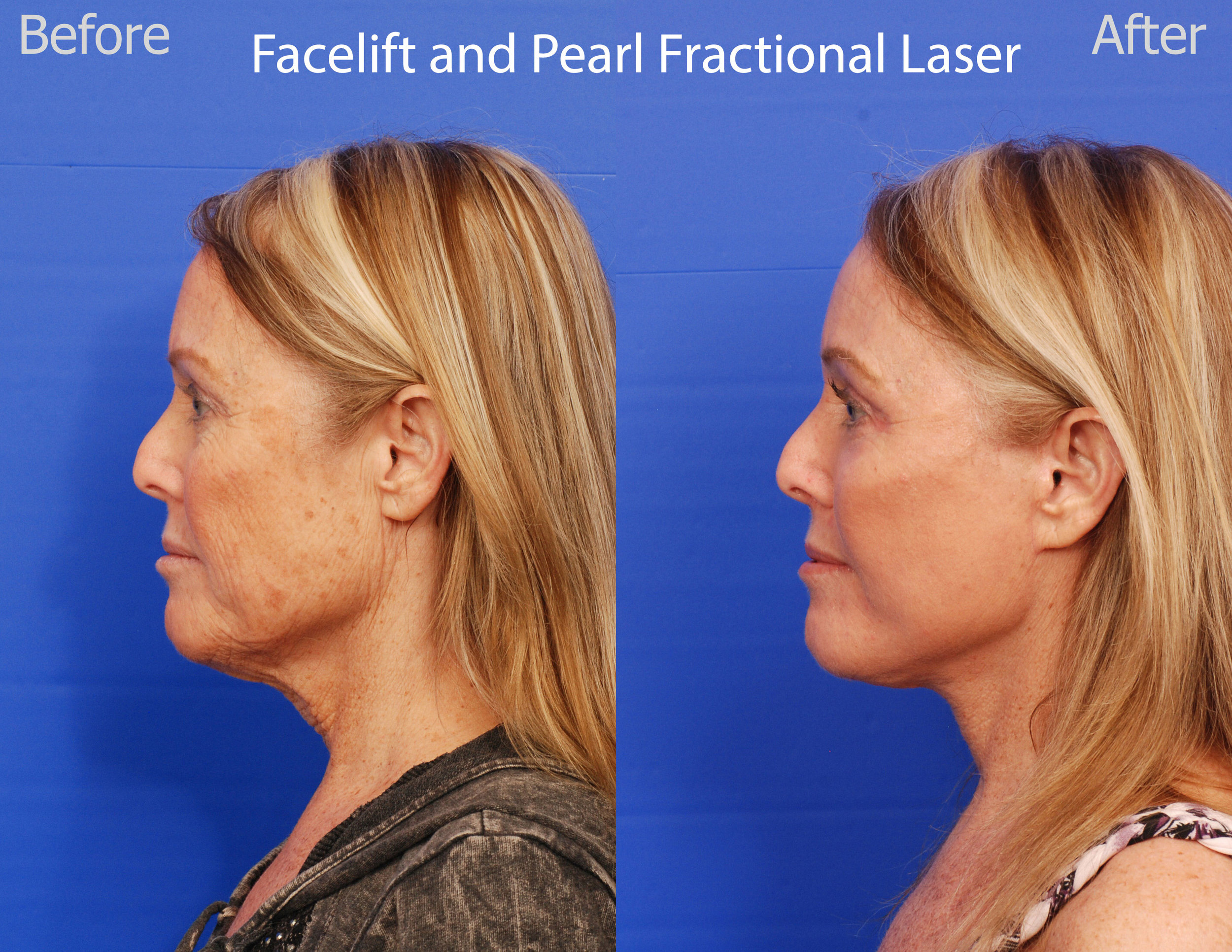 Facelift and Pearl Fractional Laser - San Diego