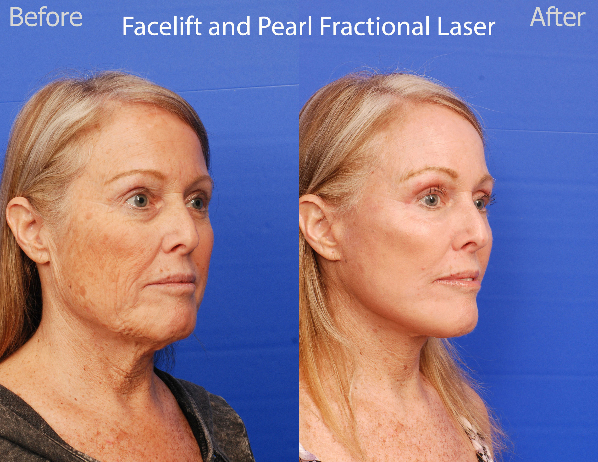 Facelift and Pearl Fractional Laser - San Diego