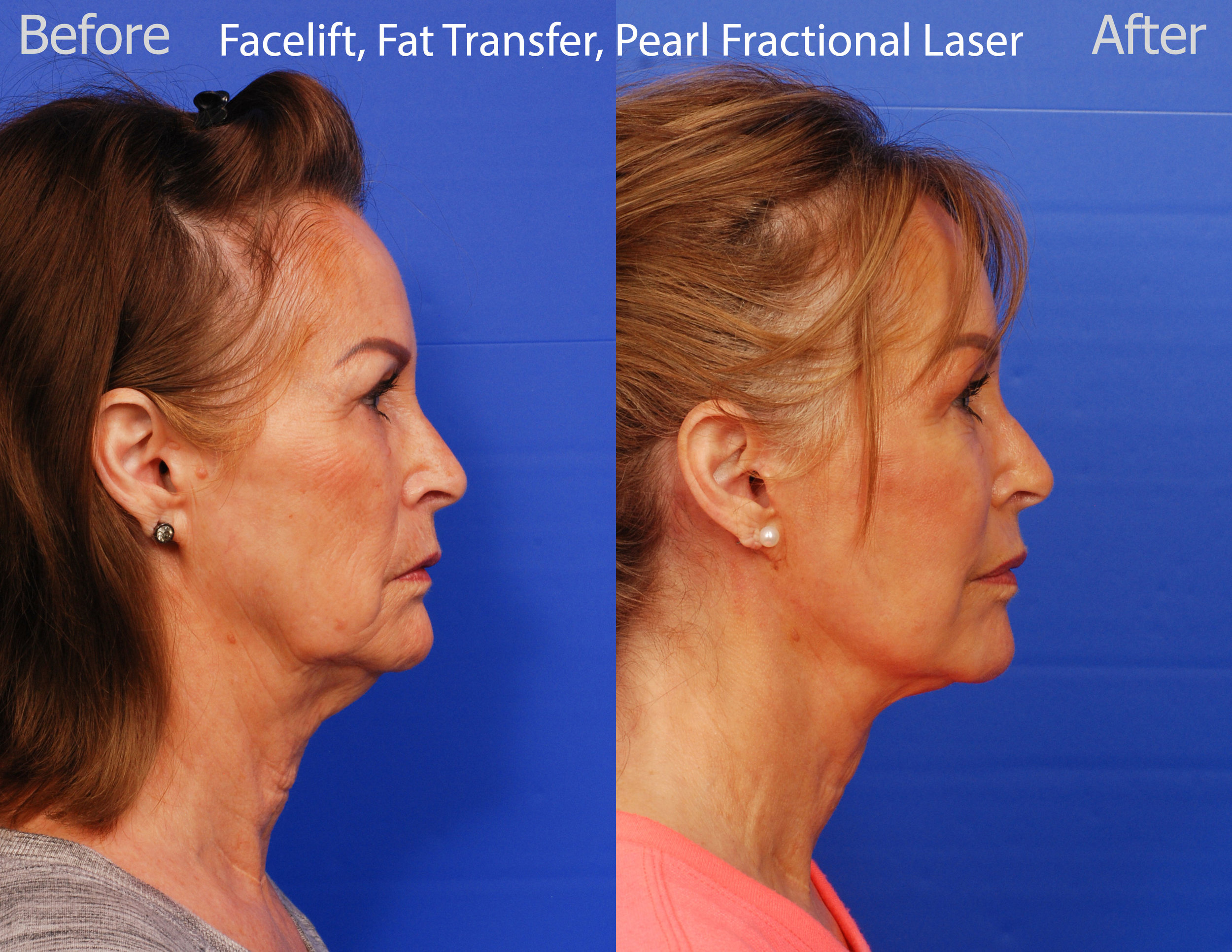 Facelift, Pearl Fractional Laser and Fat Transfer - San Diego