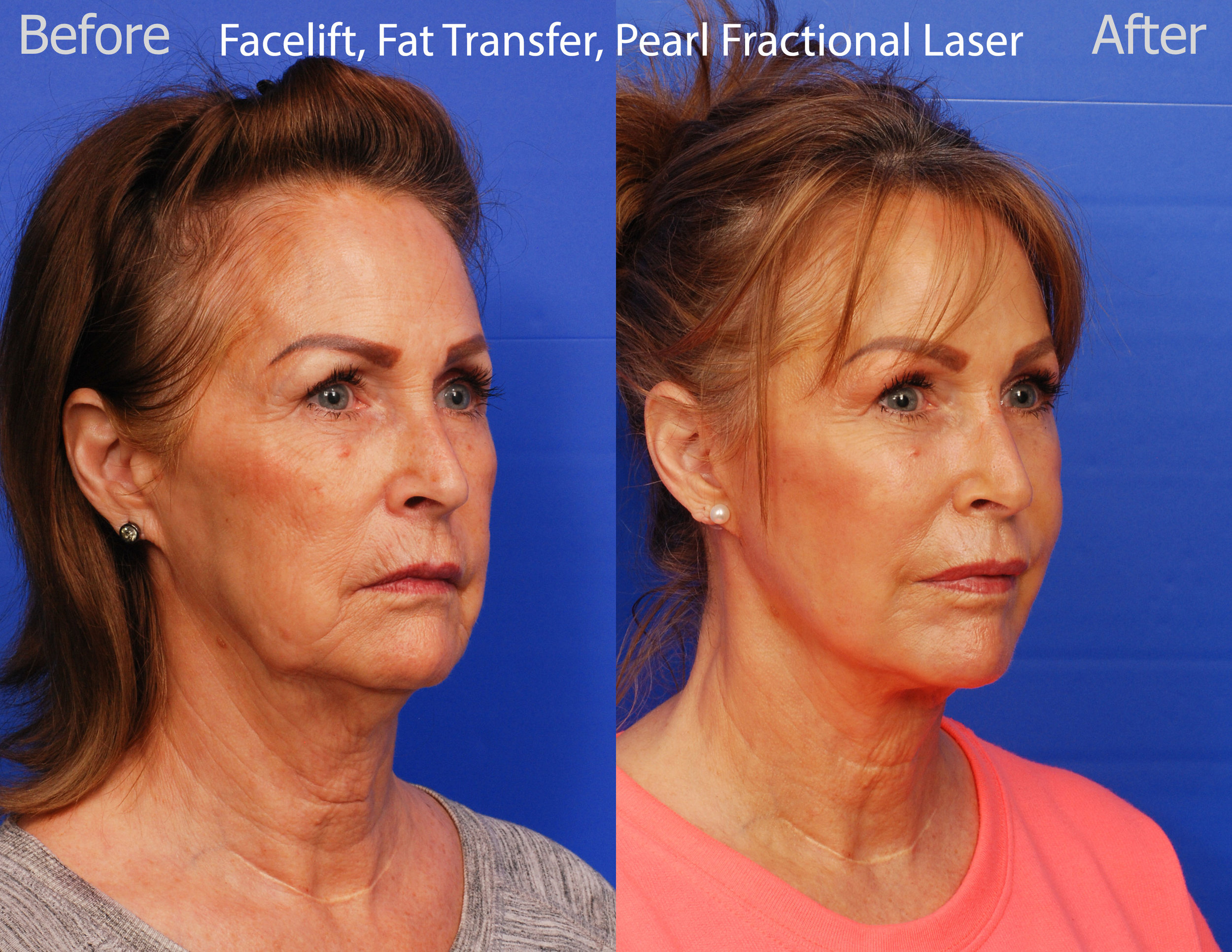 Facelift, Pearl Fractional Laser and Fat Transfer - San Diego