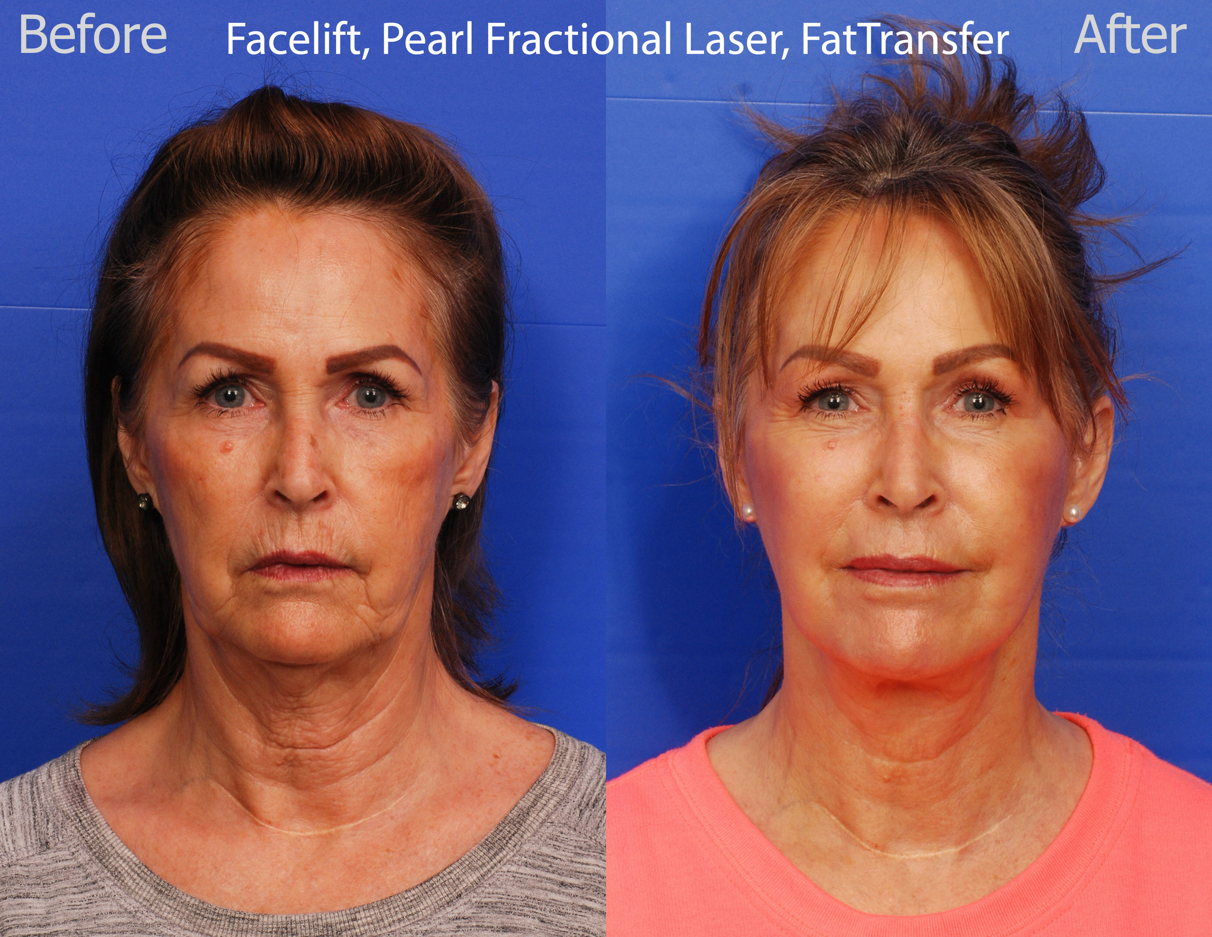 Facelift, Pearl Fractional Laser and Fat Transfer - San Diego