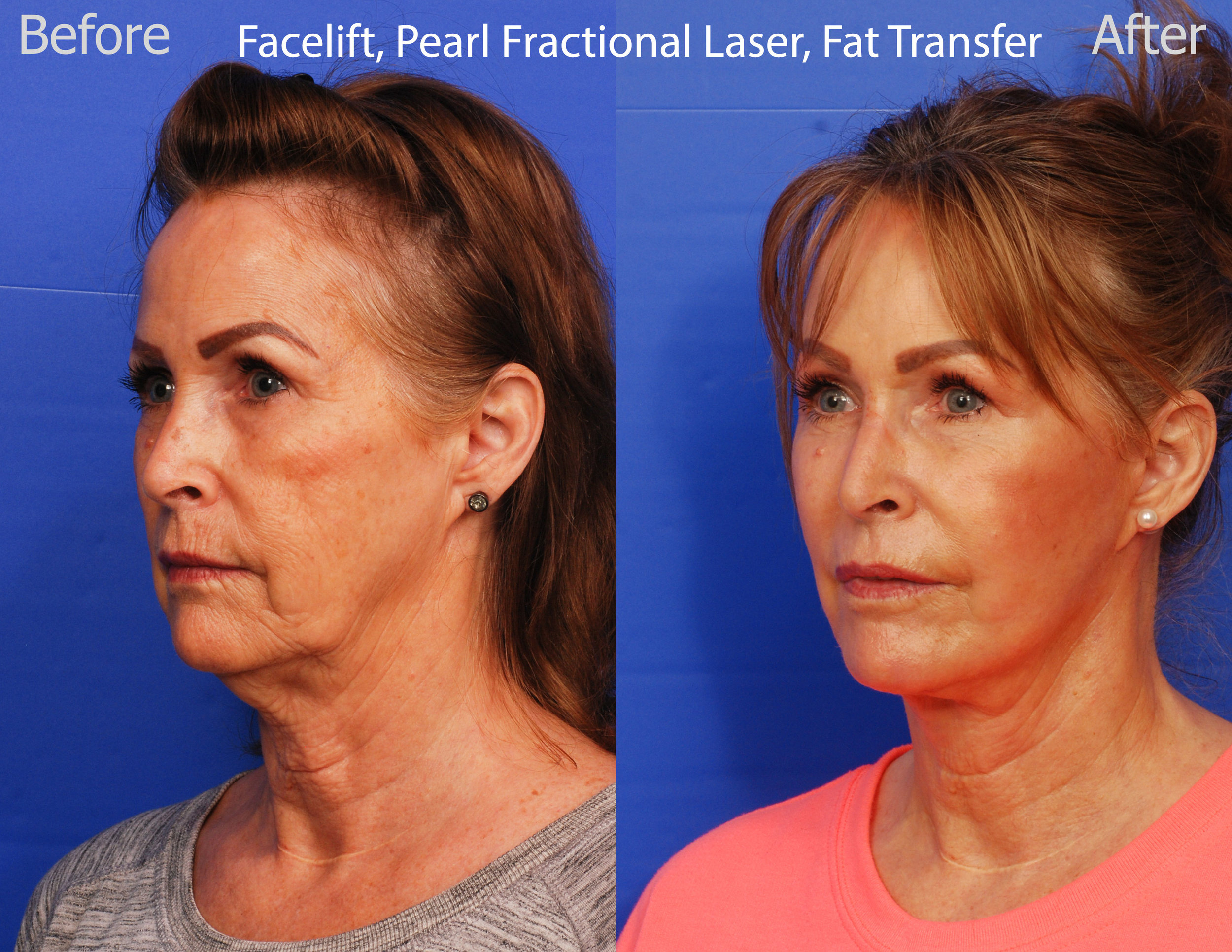 Facelift, Pearl Fractional Laser and Fat Transfer - San Diego