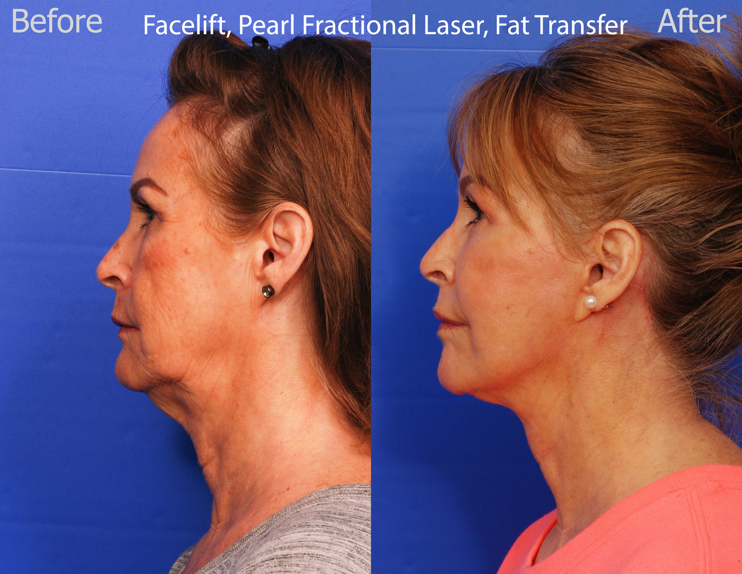 Facelift, Pearl Fractional Laser and Fat Transfer - San Diego