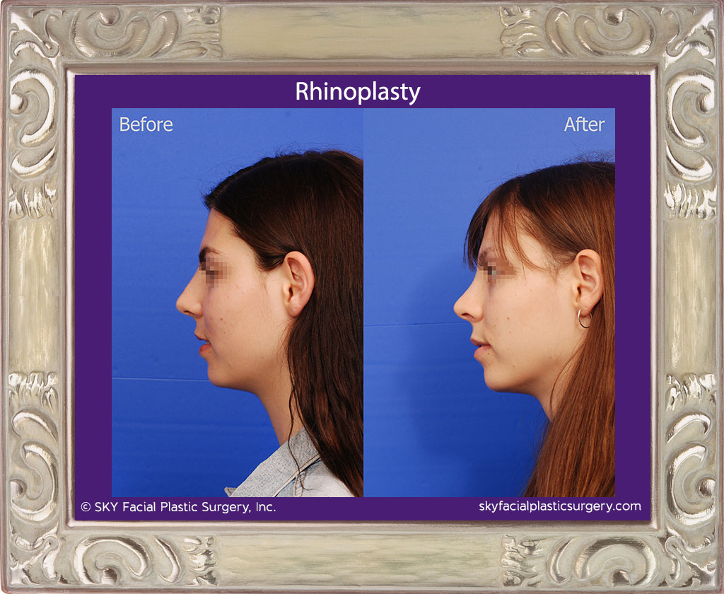 Rhinoplasty - San Diego